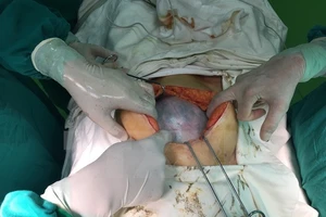 Khối u buồng trứng nặng 3,7kg được lấy ra sau khi phẫu thuật