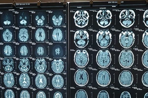 Hình ảnh chẩn đoán nhồi máu não của người đàn ông nước ngoài