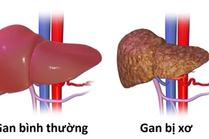 Ai là người dễ mắc bệnh ung thư gan?