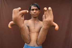 Bàn tay “khủng” của cậu bé Tarik ở bang Uttar Pradesh (Ấn Độ). Ảnh: Rareshot / Barcroft Images
