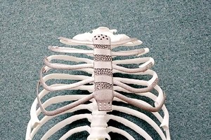 Ghép xương công nghệ in 3D