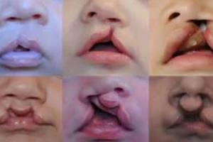 Phẫu thuật nhân đạo 120 trẻ hở môi, vòm miệng