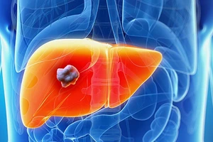 Hợp chất nhân tạo ngăn ung thư gan tái phát