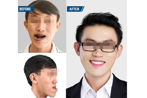 Hình ảnh bệnh nhân Ng.D.P. trước và sau phẫu thuật