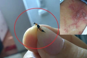 Kiến ba khoang (hình lớn) và một người bị viêm da dị ứng do độc chất từ kiến ba khoang (hình nhỏ)