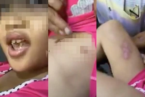 Hình ảnh bé gái 6 tuổi bị hành hạ, châm thuốc lá vào người.
