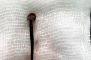 Gắp con đĩa dài 4cm trong hốc mũi bệnh nhân
