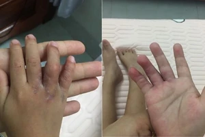 2 bàn tay sau phẫu thuật