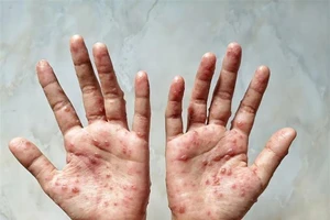 Các ban đỏ nổi trên tay một bệnh nhân mắc đậu mùa khỉ. Ảnh: Shutterstock/TTXVN
