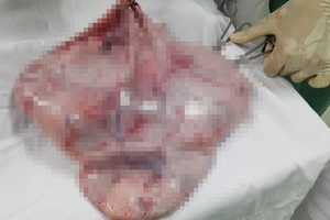 Cô gái 19 tuổi mang khối u buồng trứng 8,5kg