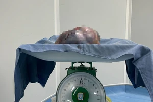 Phẫu thuật khối u buồng trứng nặng 5,2kg
