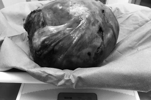 Phẫu thuật thành công khối u xơ tử cung nặng hơn 4kg 