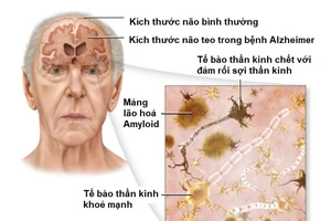 Cơ chế gây bệnh của bệnh Alzheimer và mức độ teo ở người bệnh Alzheimer