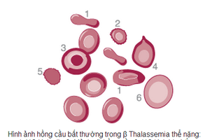 Woman with Thalassemia has a healthy son