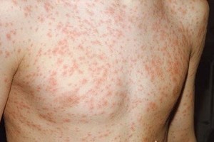 Measles outbreaks continue to escalate in South Vietnam