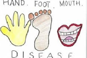 Hand-foot-mouth, measles cases running rampant in South Vietnam