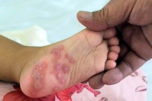 18 month old toddler in central province dies of HFM disease