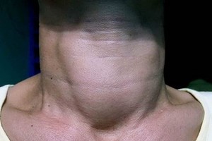 Vietnam one of top iodine-deficient countries