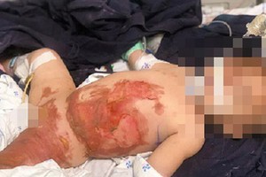 Increase in hospitalizations of burned kids