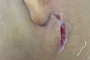 Three kids in Nghe An infected with Whitmore’s disease