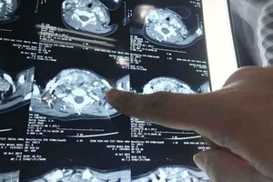 Scan of the toddler's tumor (Photo: SGGP)