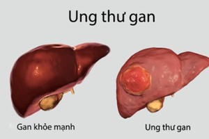 Liver cancer kills about 25,000 people yearly in Vietnam