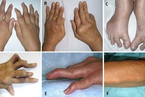 Number of Vietnamese rheumatoid arthritis patients escalating