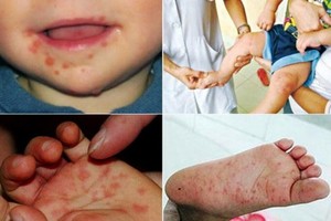 Ministry requests hospitals to monitor rise in hand-foot-mouth cases