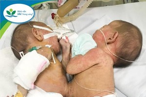 Rare conjoined twins with cardiac abnormalities share a liver