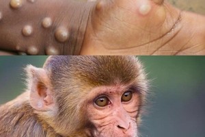 Monkeypox spreads through sex: Ministry