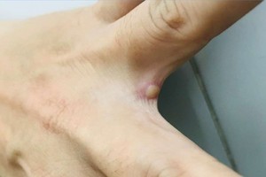 Vietnam’s first monkeypox patient completely cured