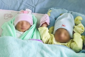Twin with one in amniotic sac given birth in Vietnam