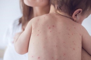 Two outbreaks of chickenpox reported in Central Highlands