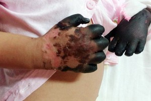 Ministry urges to well monitor cases of skin anthrax 