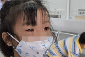 Ophthalmologists warned against self-medication to treat pink eye