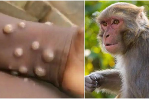 Vietnam likely to record more new monkeypox cases: Ministry