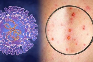 Mekong Delta province records first monkeypox case