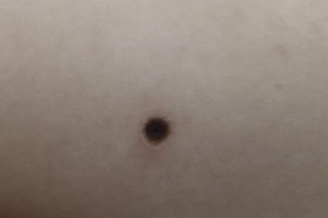 First case of Scrub typhus recorded in South region 