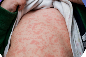 Medical workers fear widespread measles in HCMC after detecting new cases