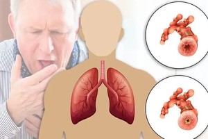 COPD could be silent but dangerous killer