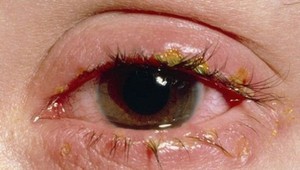 HCMC records 63,309 pink eye cases in first eight months of 2023