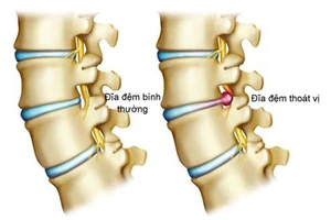 Đắp thuốc, nắn xương, bấm huyệt không chữa được thoát vị đĩa đệm