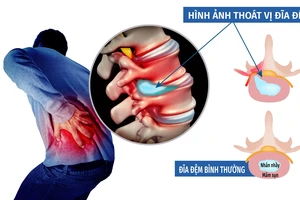 Thoát vị đĩa đệm, bệnh của cuộc sống hiện đại