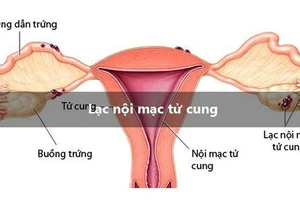 Lạc nội mạc tử cung - thủ phạm chính gây vô sinh