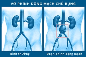 Cứu kịp thời cụ ông vỡ phình động mạch chậu chung 