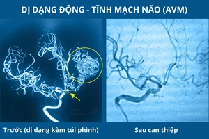 Hình ảnh chụp CT mạch máu não của bệnh nhân trước và sau khi can thiệp