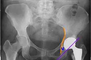 Kỹ thuật mới trong thay khớp háng, bệnh nhân xuất viện sau 24 giờ