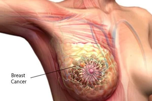 Tin vui cho các bệnh nhân ung thư vú di căn