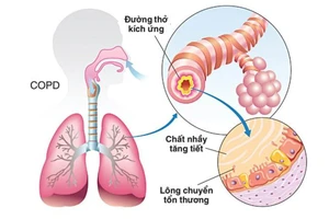 Bệnh phổi tắc nghẽn mãn tính - Sát thủ thầm lặng