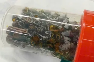 Bệnh viện Đại học Y dược Shing Mark mổ nội soi lấy hơn 100 viên sỏi trong túi mật của một bệnh nhân nữ